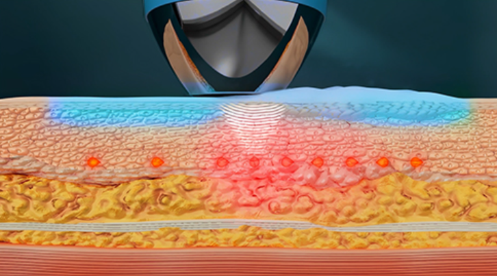 쿨소닉 가격 후기 유지기간 효과 리프팅 쿨페이즈 차이 총정리 3 image 9